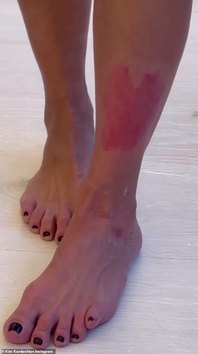 The painful condition left red, blotchy marks on Ms Kardashian's legs when flare-ups struck