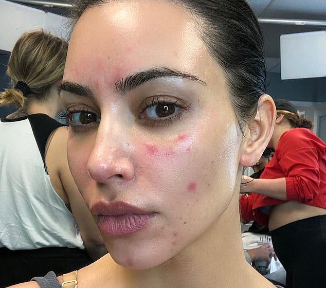  The psoriasis explosion – and how to cure it WITHOUT drugs: As cases soar, how so many go on to develop devastating conditions and doctors misdiagnose them. Now ETHAN ENNELS talks to world-renowned experts and reveals the answers