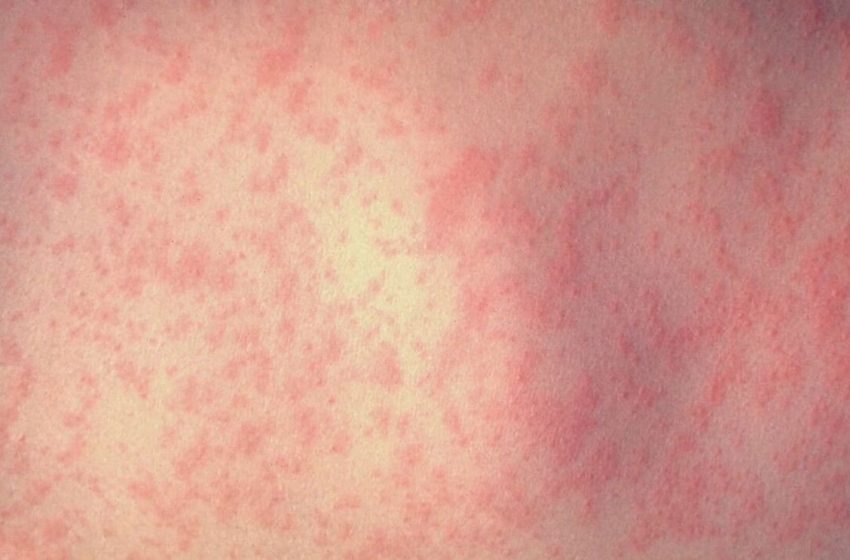  Measles confirmed at Safeway in Portland, health officials say