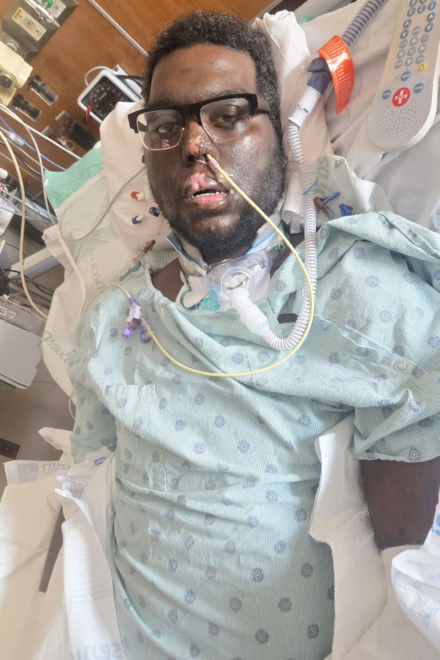 Davon Vanterpool's family is raising money to help him adjust to life without limbsCredit: Kennedy News and Media