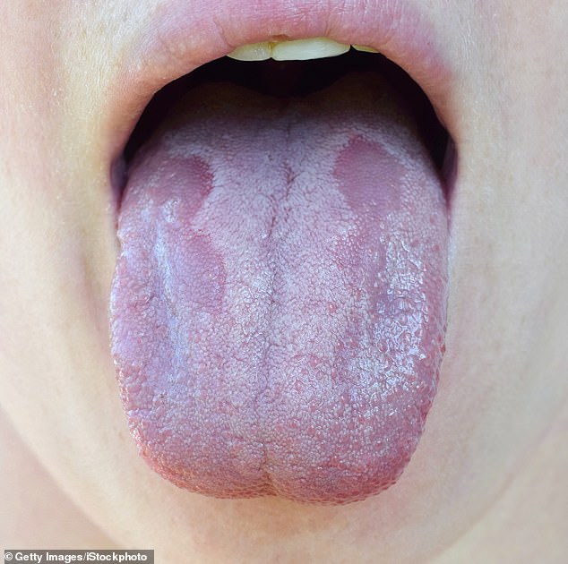 White patches on the tongue may be a sign of a fungal infection, dentists have noted (stock image)