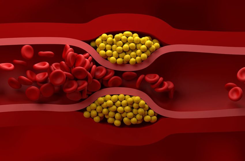  US Cardiologists Have Just Published New Guidelines For Managing Cholesterol : ScienceAlert
