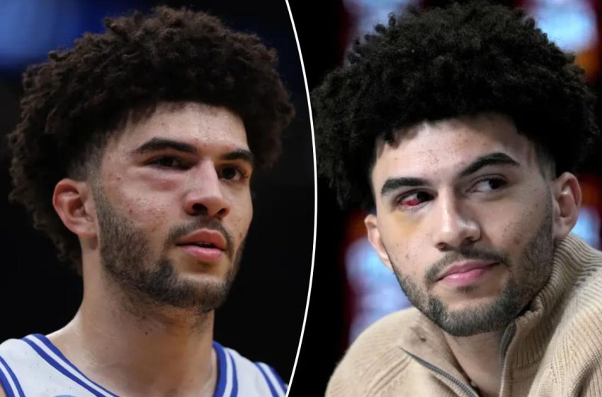  Cameron Boozer suffered multiple facial fractures in loss to UConn