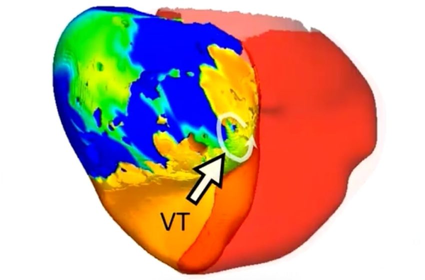  Doctors Treated a Deadly Heart Rhythm With Help From a Digital Twin : ScienceAlert
