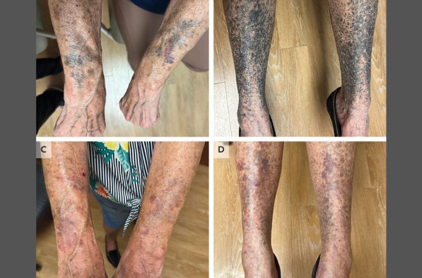  Antibiotics Turned This Woman’s Limbs Into an Unsettling Horrorshow