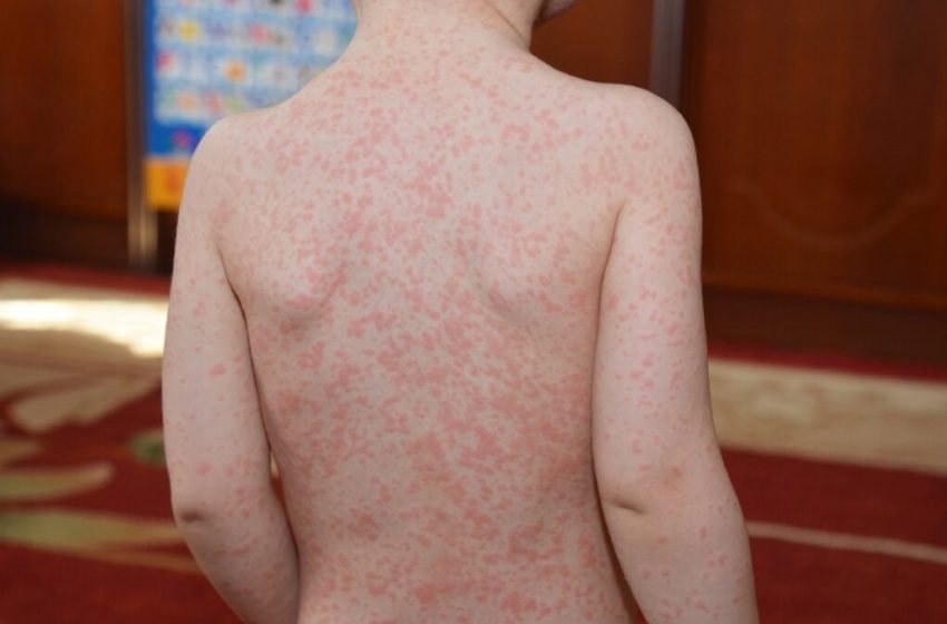  That Teenage Bout of Mono May Have a Troubling Second Act