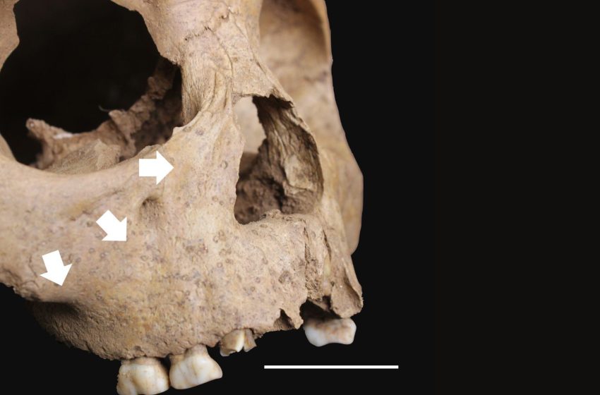  The remains of children from ancient Vietnam may challenge theories about origin of syphilis