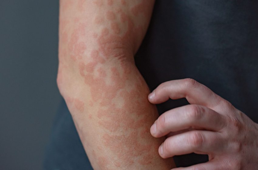  Keratin may play unsung role in skin conditions like psoriasis