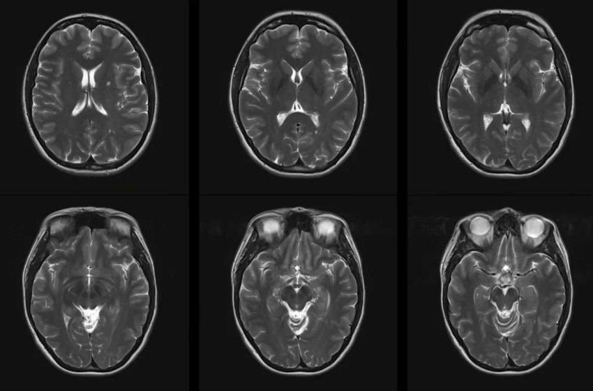  Scientists warn of increased risk of developing MS from long-term air pollution exposure