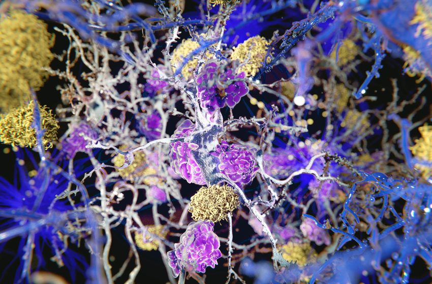  Alzheimer’s may start in body tissue inflammation, not in the brain