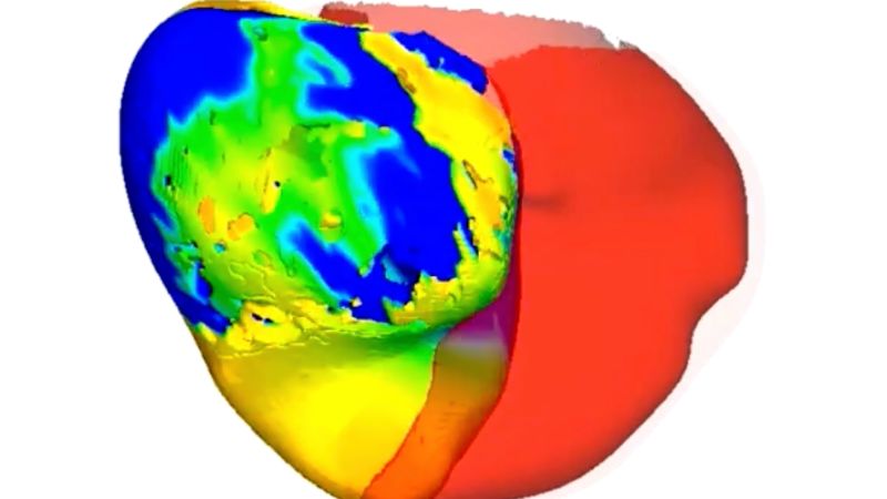  To fix a patient’s irregular heartbeat, doctors first tested its digital ‘twin’