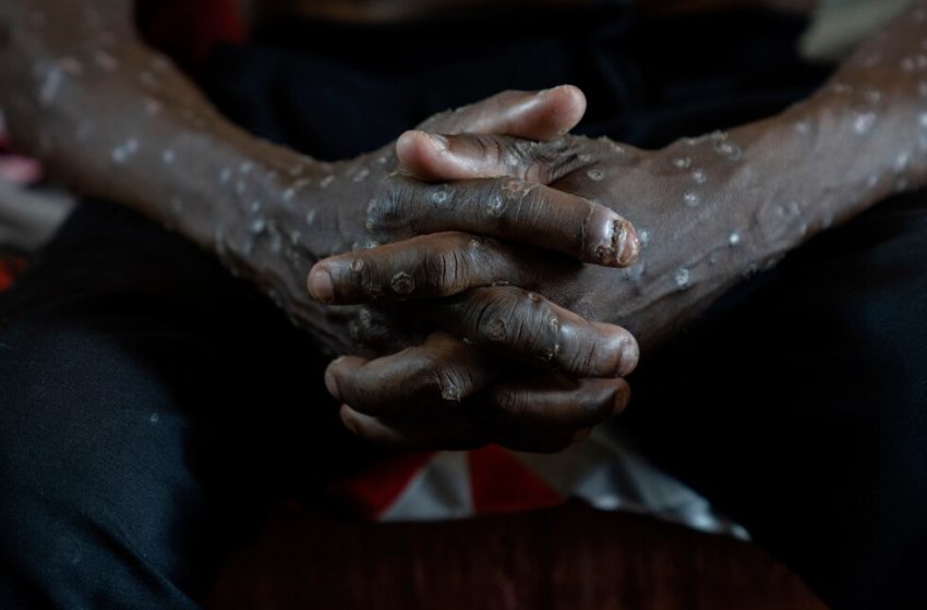  Congo says its mpox outbreak is over after 2 years and thousands of cases